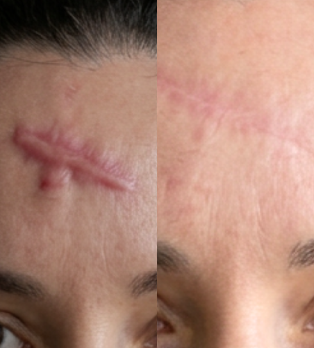ARCHER before and after result