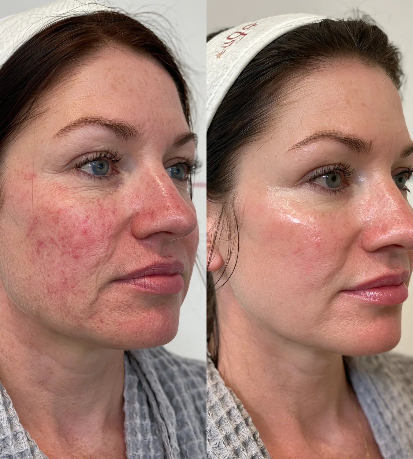 ARCHER before and after result